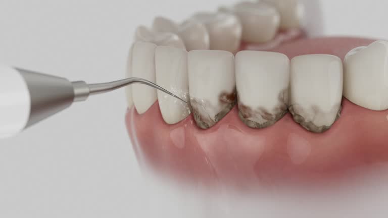 Trusted Wisdom Tooth Removal service in Cherry Valley, CA - Dentist Open Now